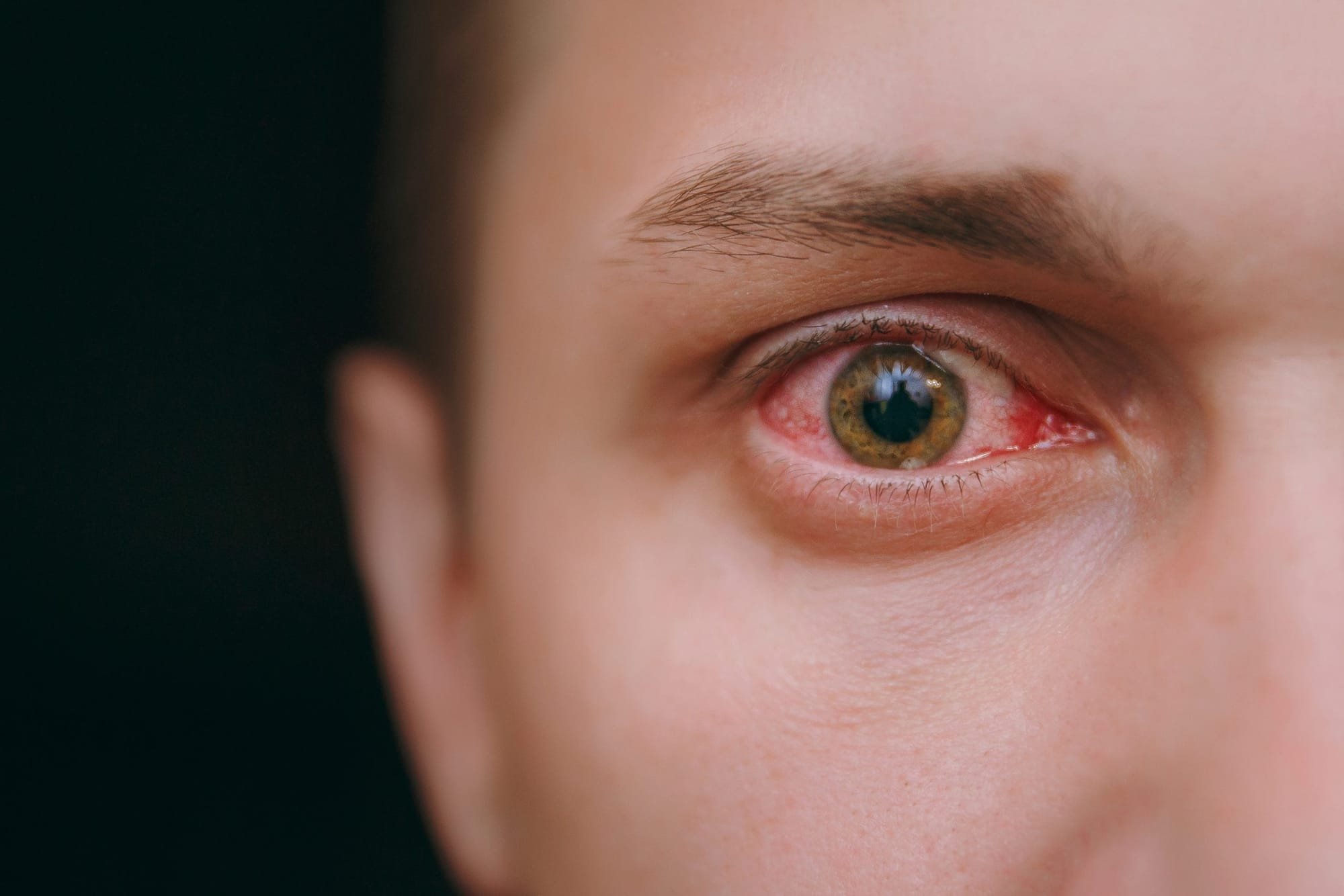 رصد أعراض جديدة لفيروس كورونا.. كلمة السر في العينين