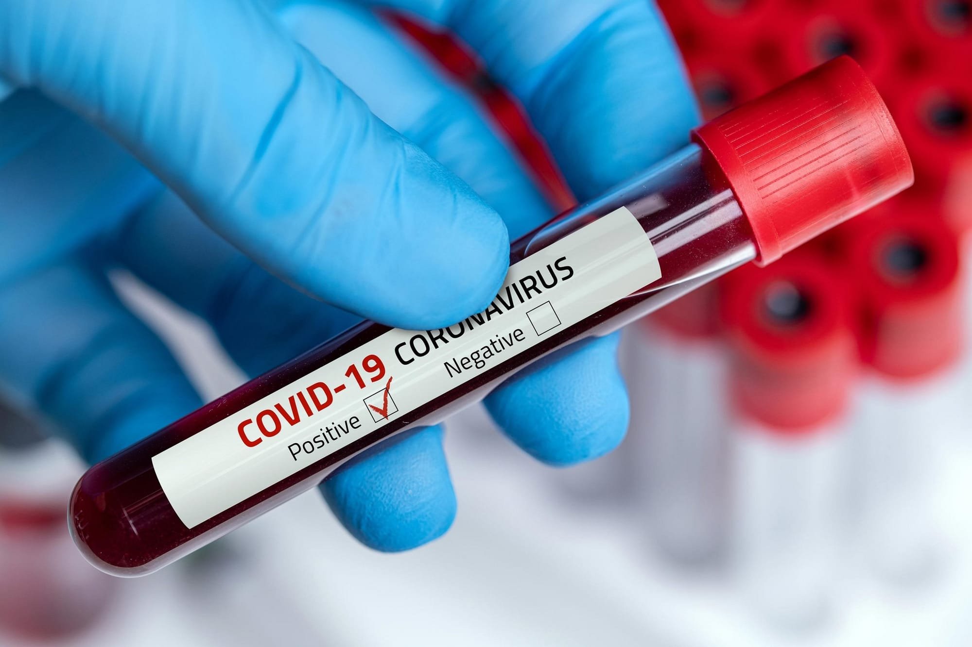 دراسة: فصيلة دم معينة تعرض أصحابها لخطر كورونا