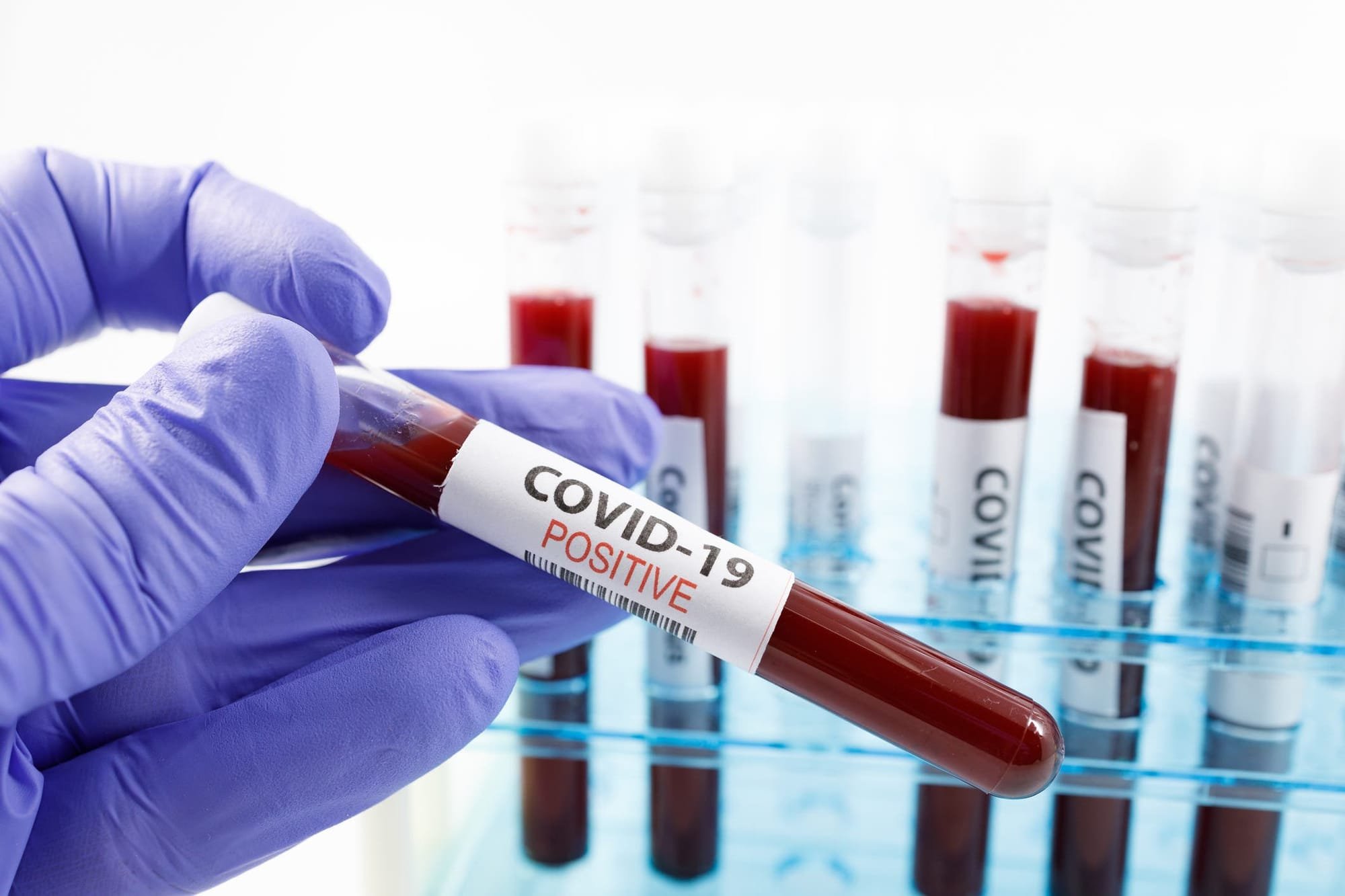 دراسة جديدة تشرح حقيقة العلاقة بين فصيلة الدم والإصابة بـ"كوفيد-19" الشديد