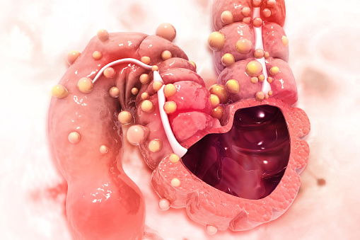 كيف نخفض نسبة الوفاة بسرطان الامعاء والمستقيم؟؟