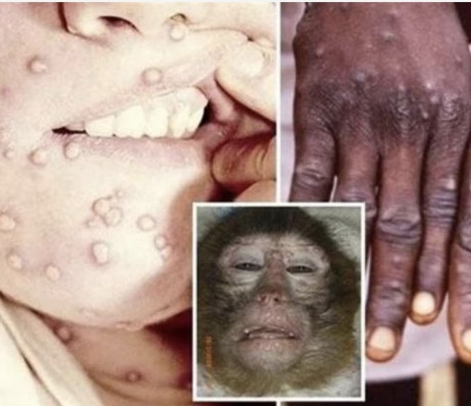 جدري القرود Monkypox ماهو وما اختلافه عن الجدري وجدري الماء