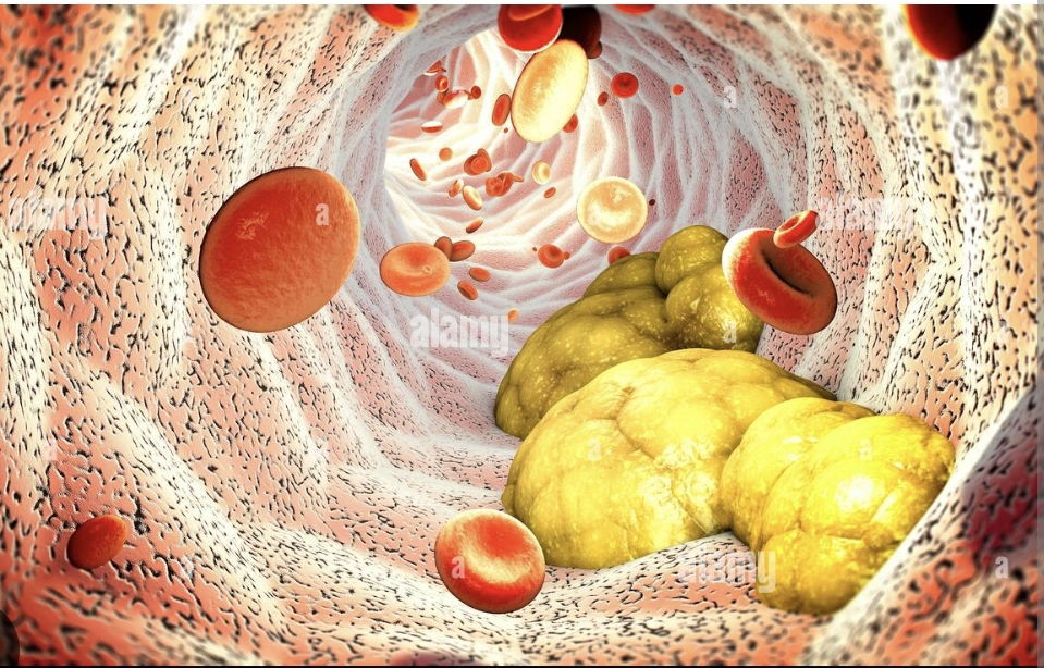 البروتين الدهني (أ)  والازمات القلبية لدى الشباب. Lipoprotein A and heart attack at a young age