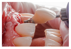 Immediate Implants and Soft Tissue Management