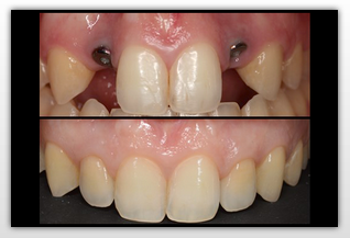 Complex Decision Making in the Esthetic Zone: The Interdisciplinary Team Approach