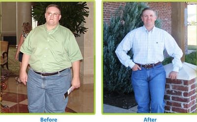 Weight Loss Surgery In Pune image