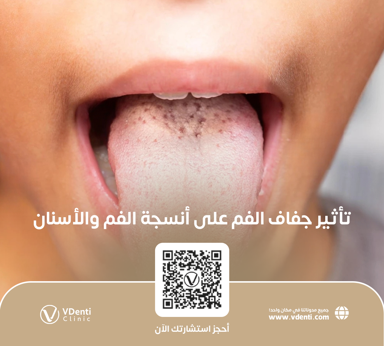 تأثير جفاف الفم على أنسجة الفم والأسنان