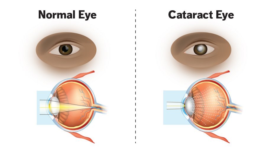Best Natural Treatment for Glaucoma and Cataract - Forever Ivision Benefits