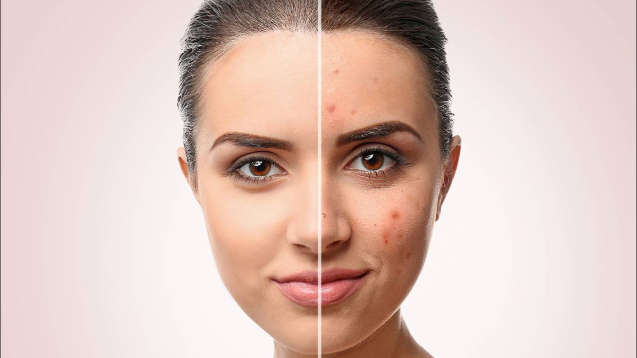 تَقنيات غير جِراحـية في تَوحيد لون البشرة وإزالة تصبـغات الوجه