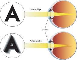 astigmatisme