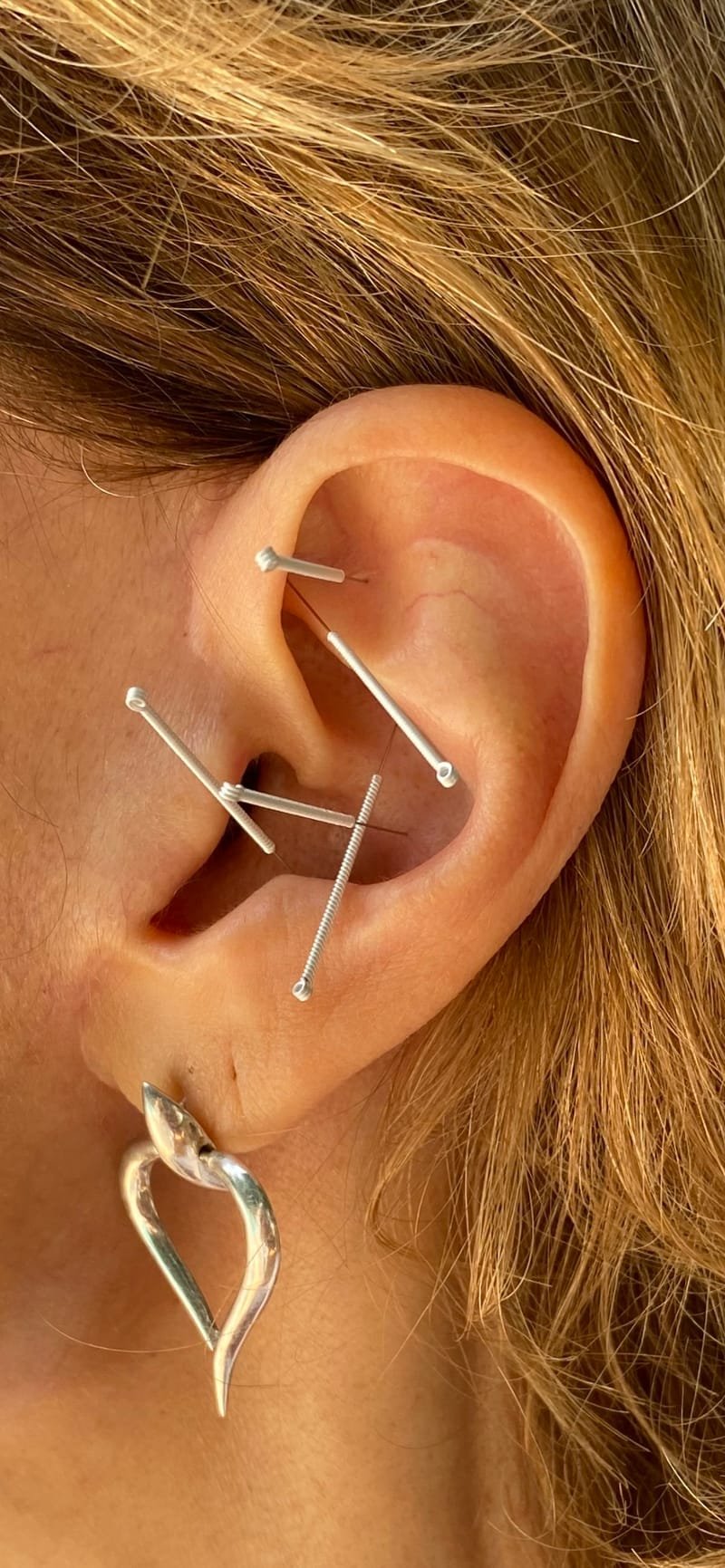 Ear Acupuncture Trial Sessions