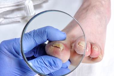 Give Nail Fungus The Boot With New Nacler