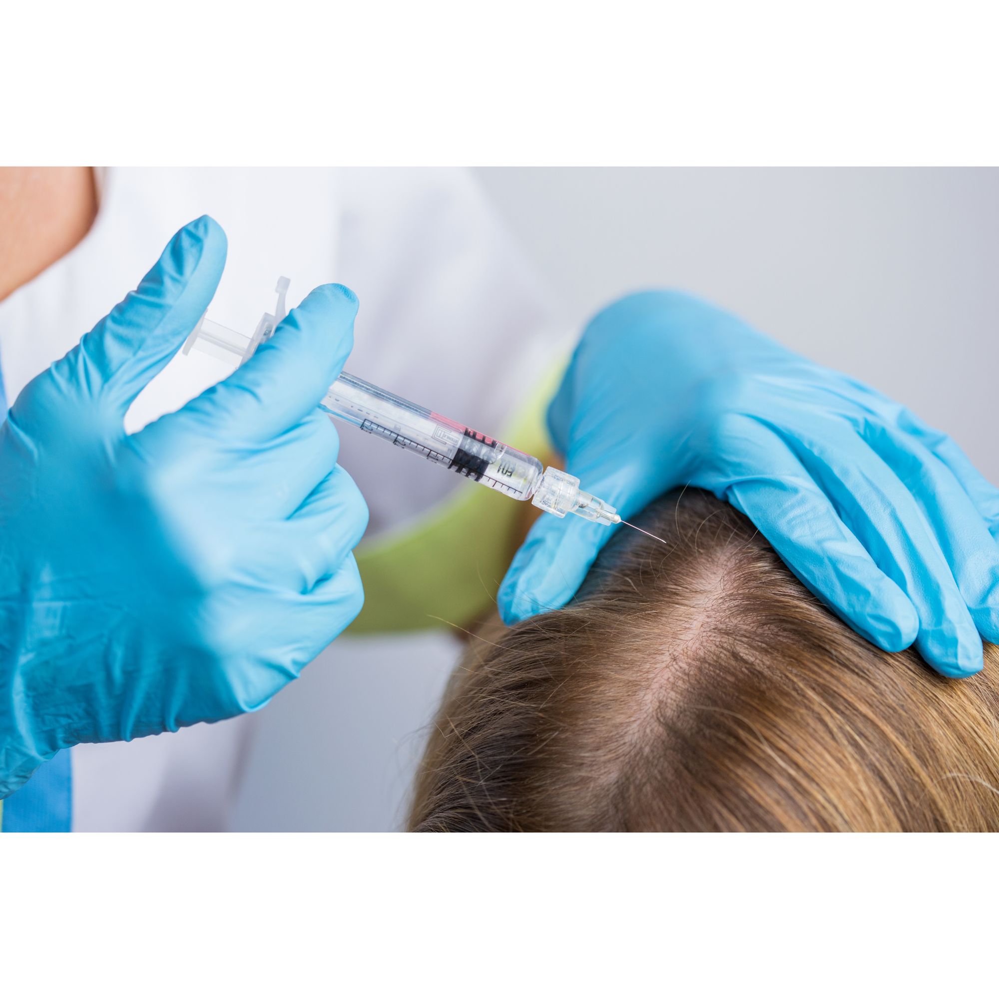 Mesoterapia Capilar