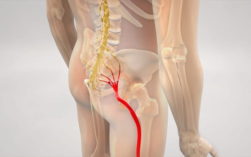 Sciatica
