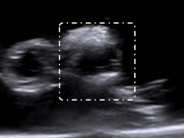 ULTRASOUND