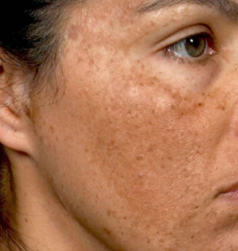 Pigmentation Disorder