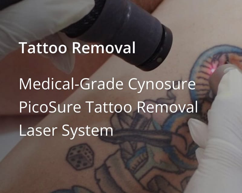 Picosure laser tattoo Removal