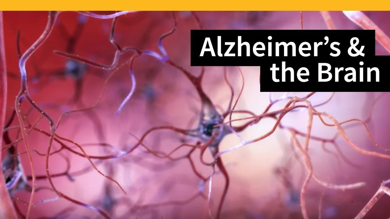 What is Alzheimer's?