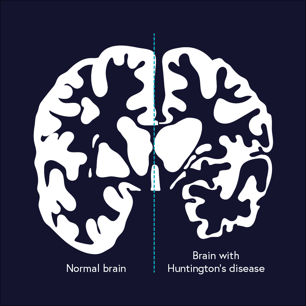 New Measure of Huntington’s Disease- Brain Age