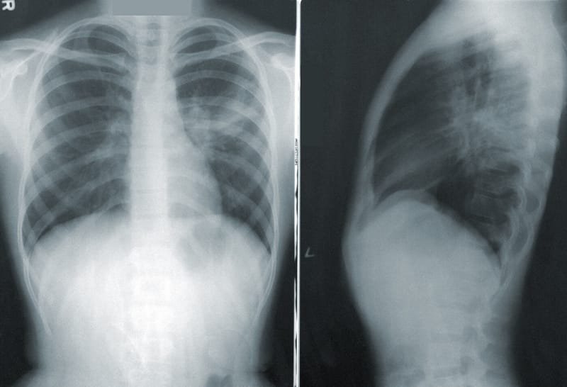 x ray of lungs with asthma