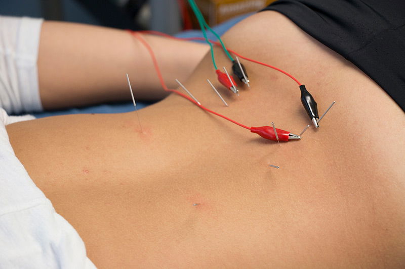 Dry Needling Electric