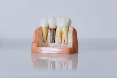 Dental Implants image