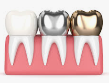 Dental Crowns