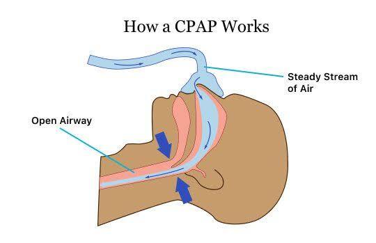 CPAP Titration - JP Clinical Neurophysiologists