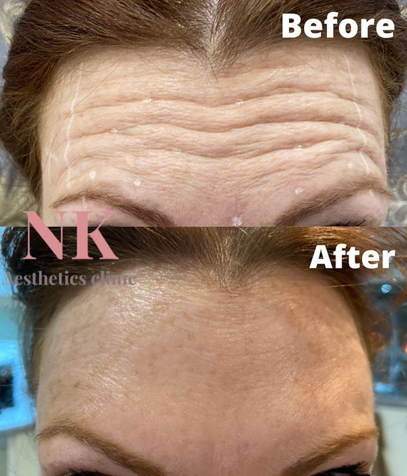 Forehead treatment using Anti-wrinkle injections