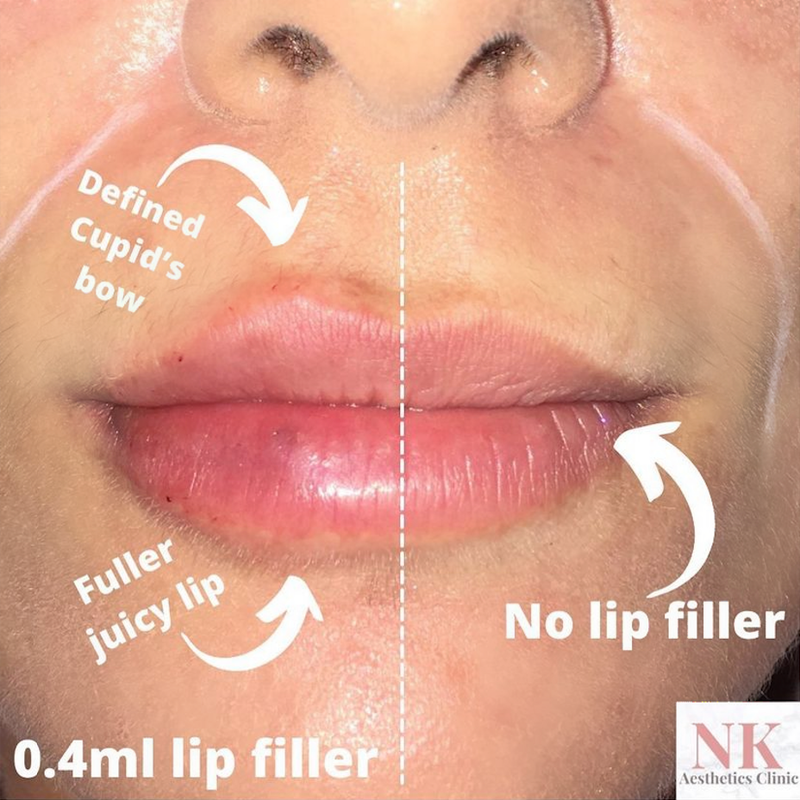 Dermal lip filler halfway injection
