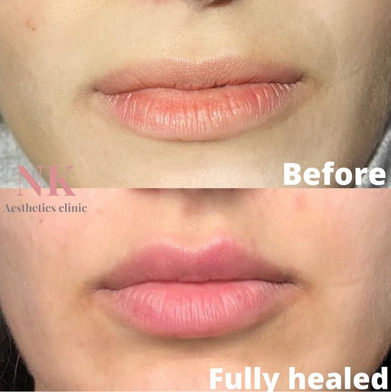 Russian lip technique (fully healed)