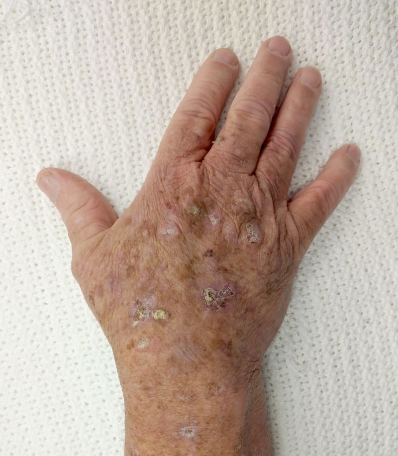 Actinic Keratosis