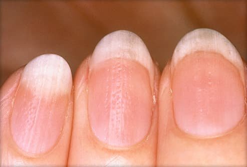 Nail Assessment for Nursing (Normal and Abnormal Findings) - YouTube