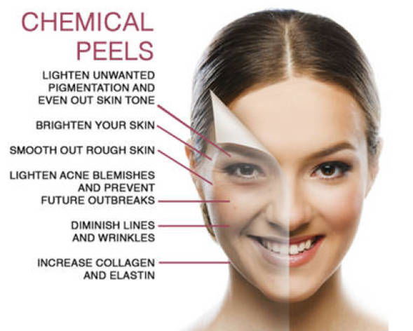 Chemical Peels