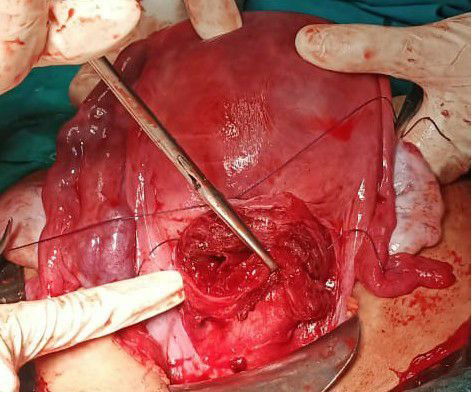 Management of Postpartum Hemorrhage due to Placenta Previa: A Case Series of Transverse B-Lynch Uterine Compression Suture