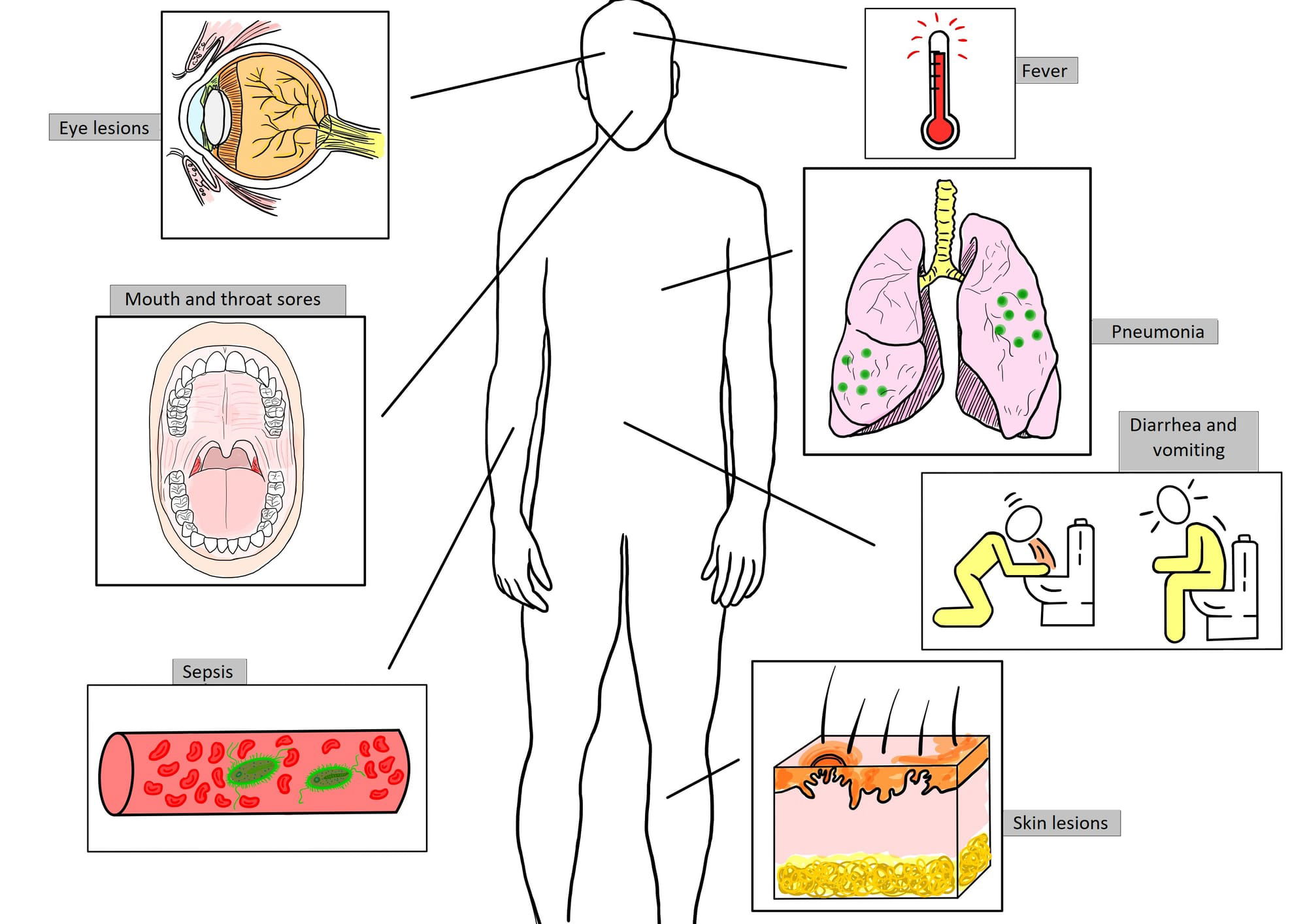 Monkeypox, a current global health issue: brief review on prevention and treatment