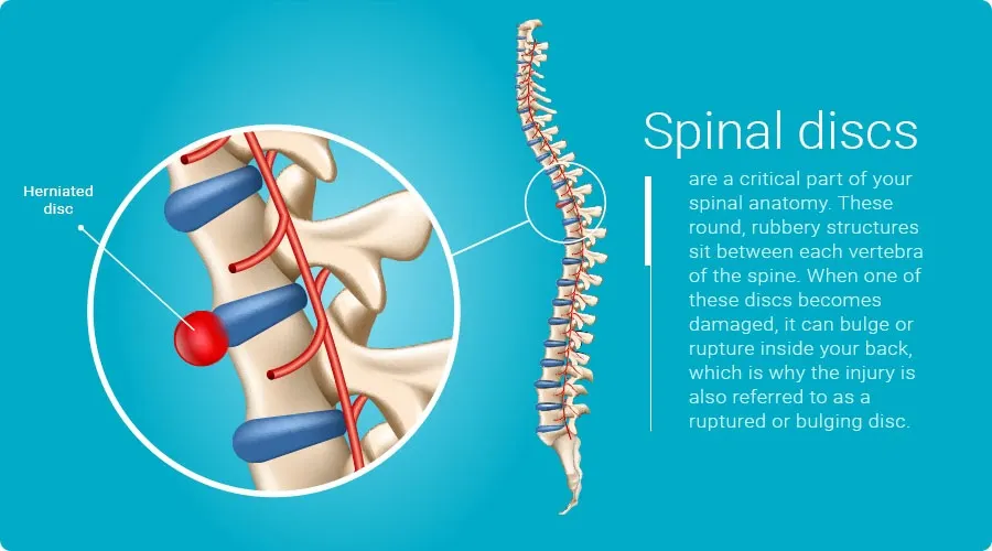 Disc Herniation - Thinking outside the box.