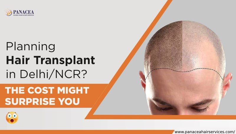 Hair Transplant Side Effects in Delhi - panaceaglobalhairservices