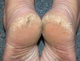 Callus -  Dry cracked heels