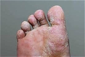 Athletes foot - Fungal foot infection