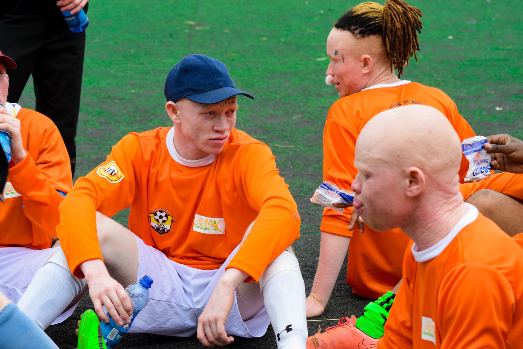 BA FOOTBALL - Black Albinism 