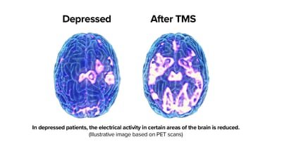 Transcranial magnetic stimulation(TMS) image