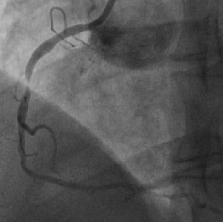 Before and After stenting example Cove Cardiology Dr Cuneyt Ada
