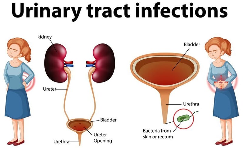 Urinary track infection (UTI) and it’s clinical management - Healthbarosa