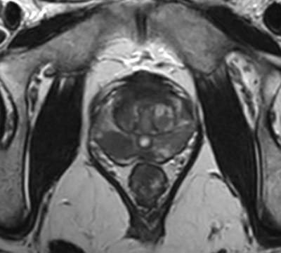 Prostate biopsy (transperineal) image