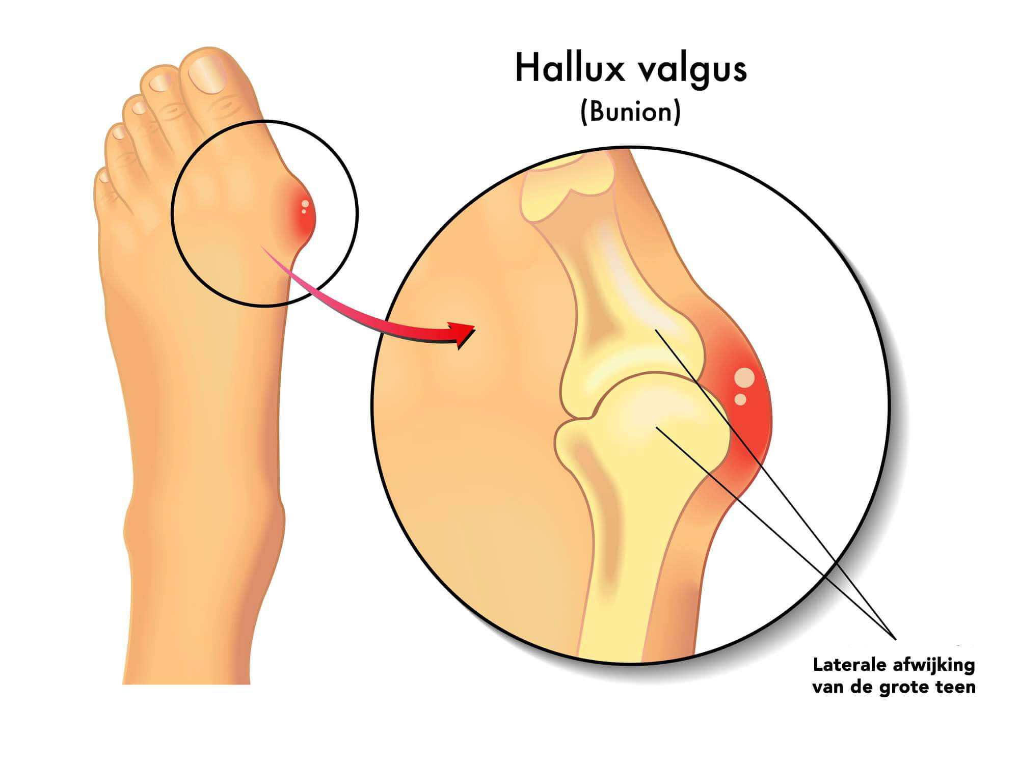 Hallux valgus