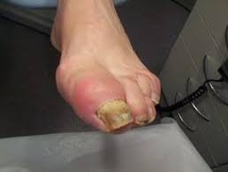 Reumatische voet