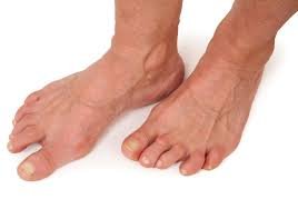 Artrose voet