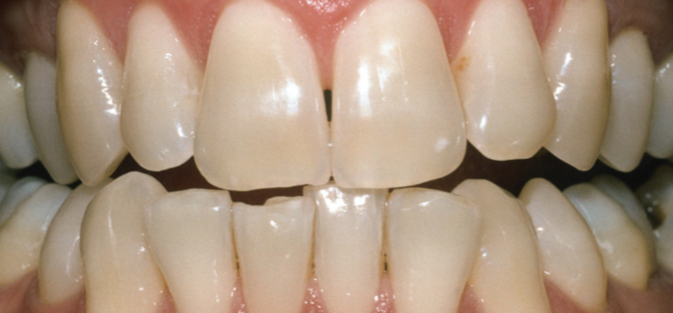 Zahnaufhellung/ Bleaching - Cite Zahnärzte