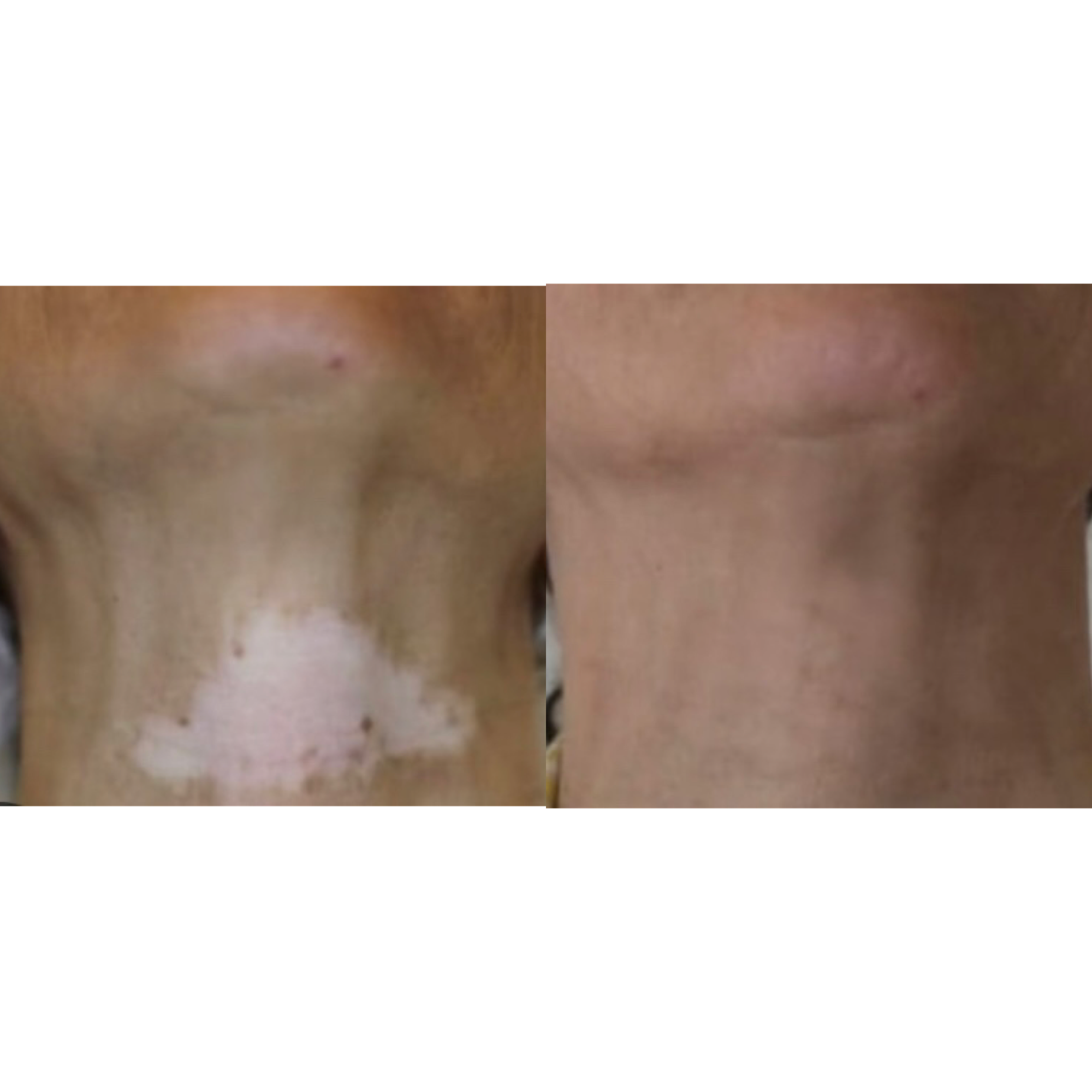 Restructuration chromatique - vitiligo