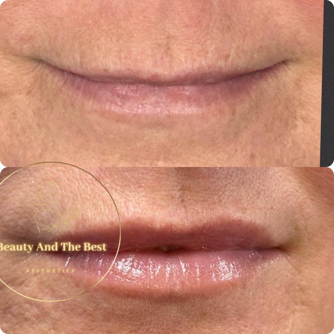 Lip Restoration Beauty and the Best Aesthetic